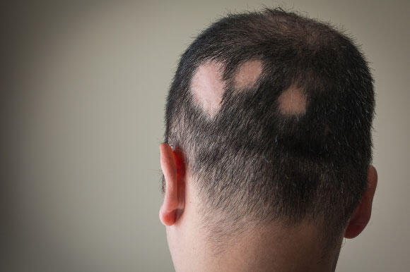 A person suffering from alopecia areata, or spot baldness 