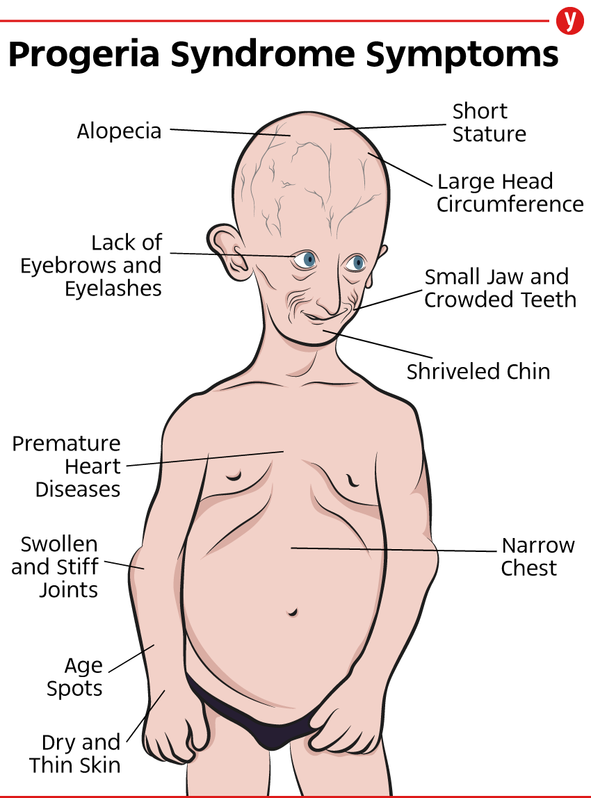 Progeria Syndrome Symptoms