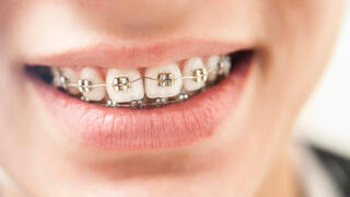 יישור שיניים באמצעות גשר