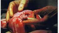 Dr. Joseph Bruner  holds hand of a fetus during an operation in 1999