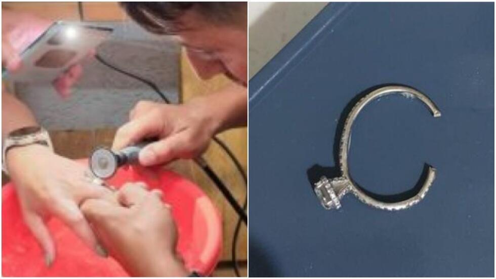 Волонтеры распиливают кольцо, чтоб спасти палец женщины; застрявшее кольцо 