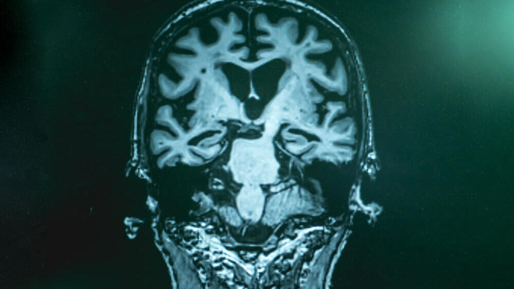 אלצהיימר דמנציה