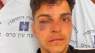 תושב מזרח ירושלים בן 16 הוכה באלימות קשה על ידי קבוצת גזענים וכוחות משטרה