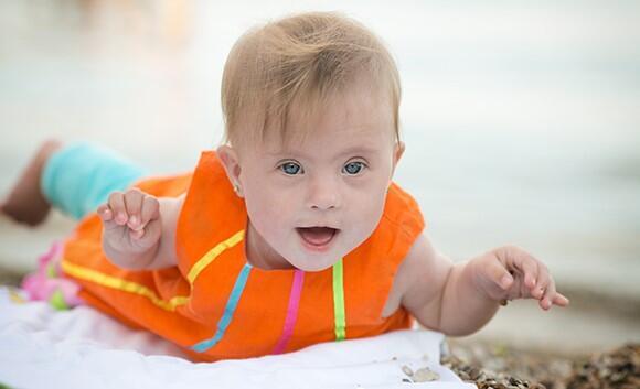 A genetic syndrome that in the vast majority of cases is not inherited from the parents. A baby with Down syndrome 