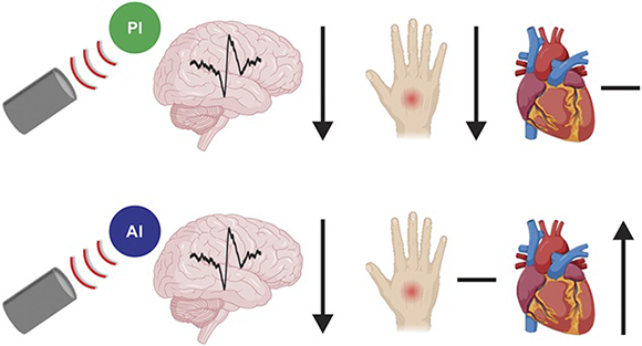 Focusing ultrasound waves on the posterior part of the insula led to pain reduction and did not affect heart rate variability (top), whereas focusing on the anterior part did not reduce pain but affected heart rate variability. Graphical summary of the experiment 