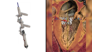 תמונת CT  של הלב, מערכת TMVR להחלפת המסתם המיטרלי שפיתחה חברת אינוולב