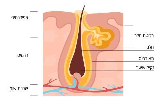 Excessive secretion of sebum may block pores and cause acne. A hair follicle and a sebum gland 