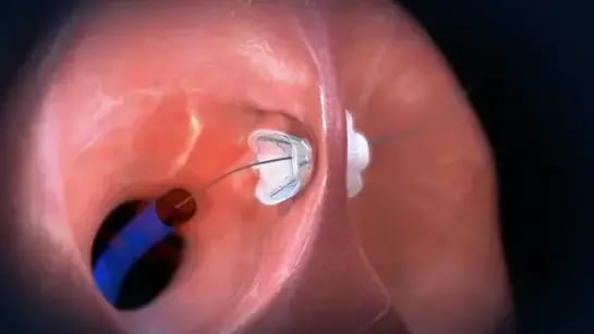 מסתם ללב של חברת ו-וייב (V-Wave) שנמכרה לחברת ג'ונסון אנד ג'ונסון