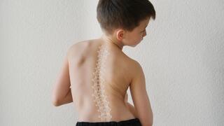 עקמת גב עקום כאבי גב ילד