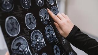 צילום MRI של מוח