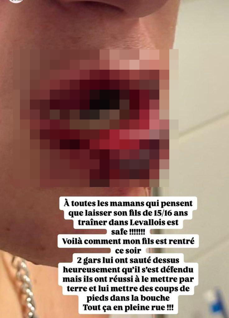The injury of the Jewish teen who was attacked in Paris 