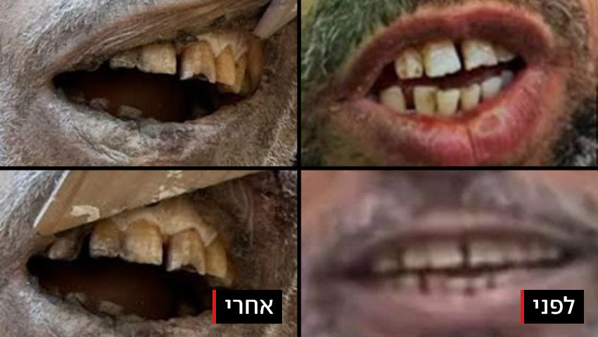 השיניים של יחיא סינוואר שהובילו לזיהוי במשטרה