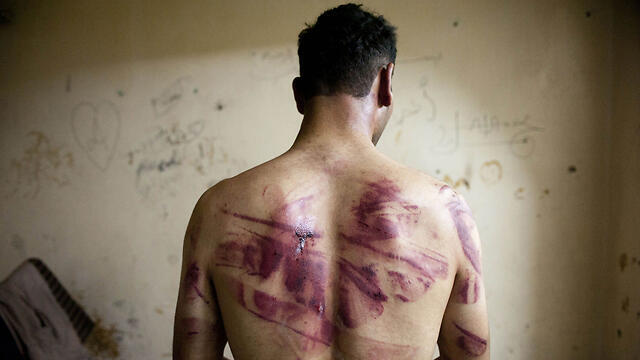 A former Syrian detainee displays marks left by torture. (Photo: AFP/Archive) (צילום: AFP) A former Syrian detainee displays marks left by torture. (Photo: AFP/Archive)