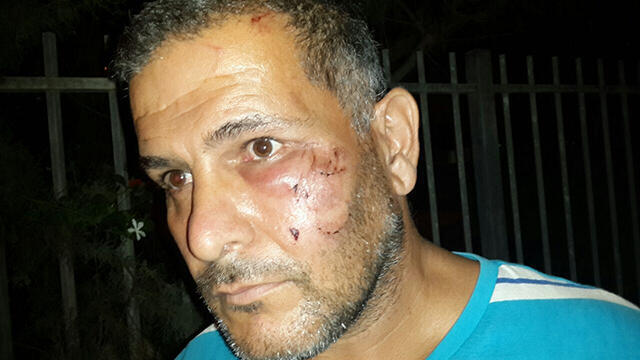 Wail Shaalan, injured in a racist attack in Netanya.