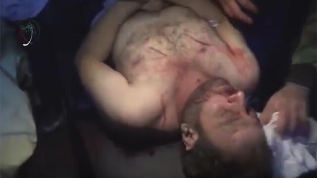 An alleged victim of Sarin gas exposure in Syria