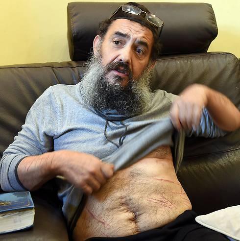 Tzion Saadon displaying the injuries he claims to have sustained in ISIS attack (Photo: AFP) (צילום: AFP) Tzion Saadon displaying the injuries he claims to have sustained in ISIS attack (Photo: AFP)