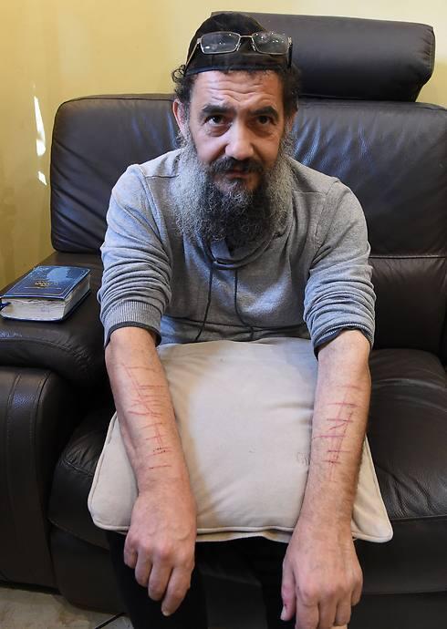 Tzion Saadon displaying the injuries he claims to have sustained in ISIS attack (Photo: AFP) (צילום: AFP) Tzion Saadon displaying the injuries he claims to have sustained in ISIS attack (Photo: AFP)