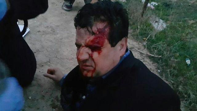 MK Ayman Odeh after he was injured in the clashes