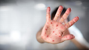 Корь, иллюстрация