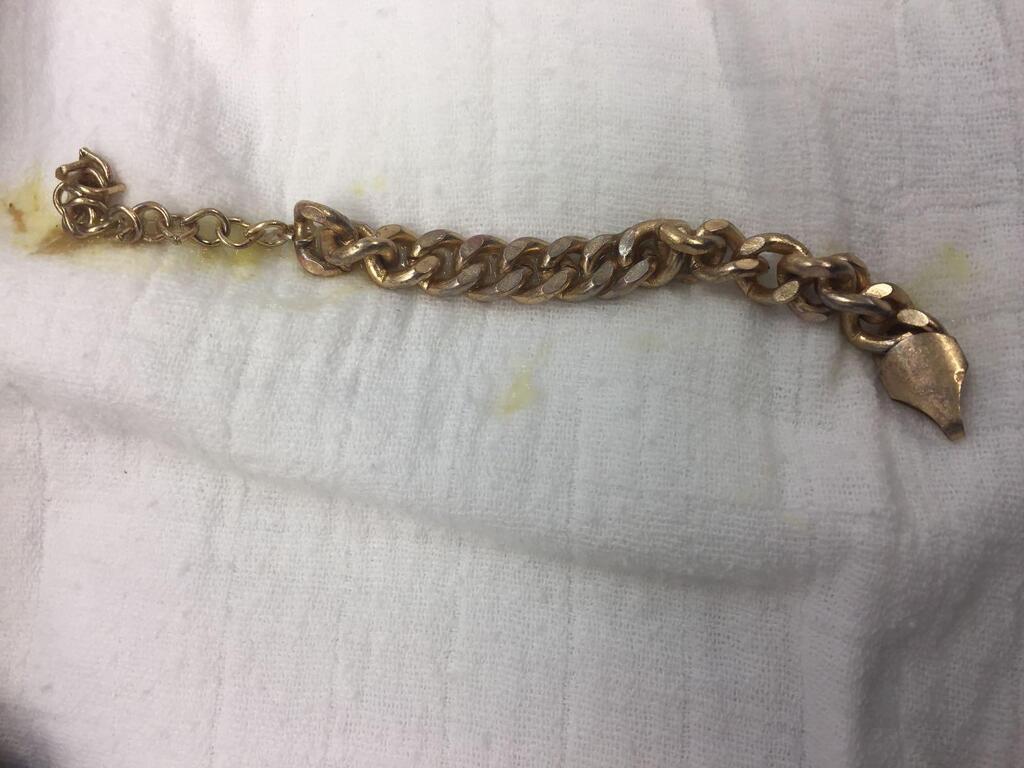 Проглоченная цепочка. Фото: пресс-служба "Рамбам"