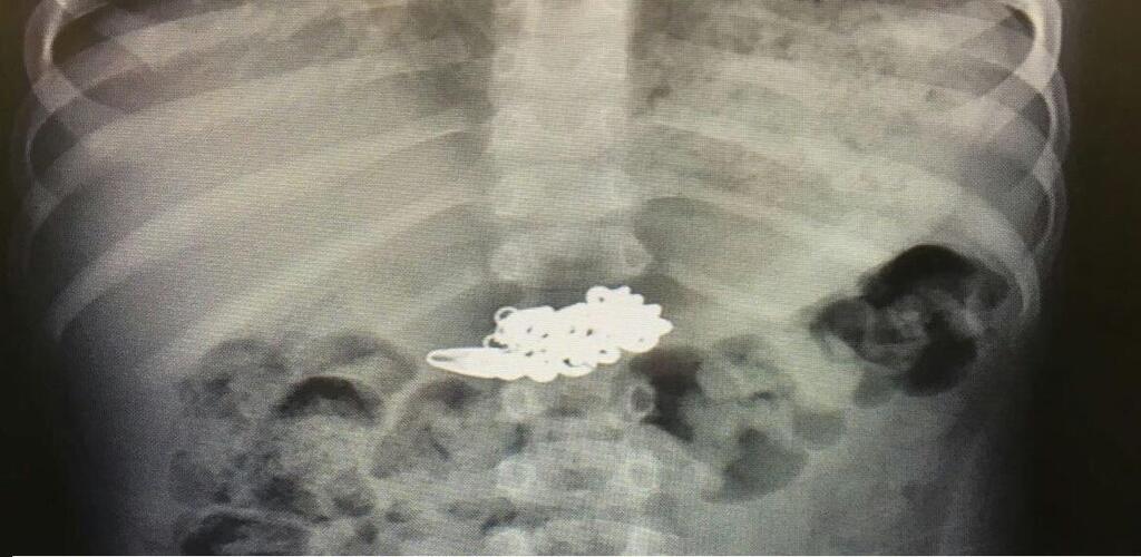 Цепочка на рентгеновском снимке. Фото: пресс-служба "Рамбам"