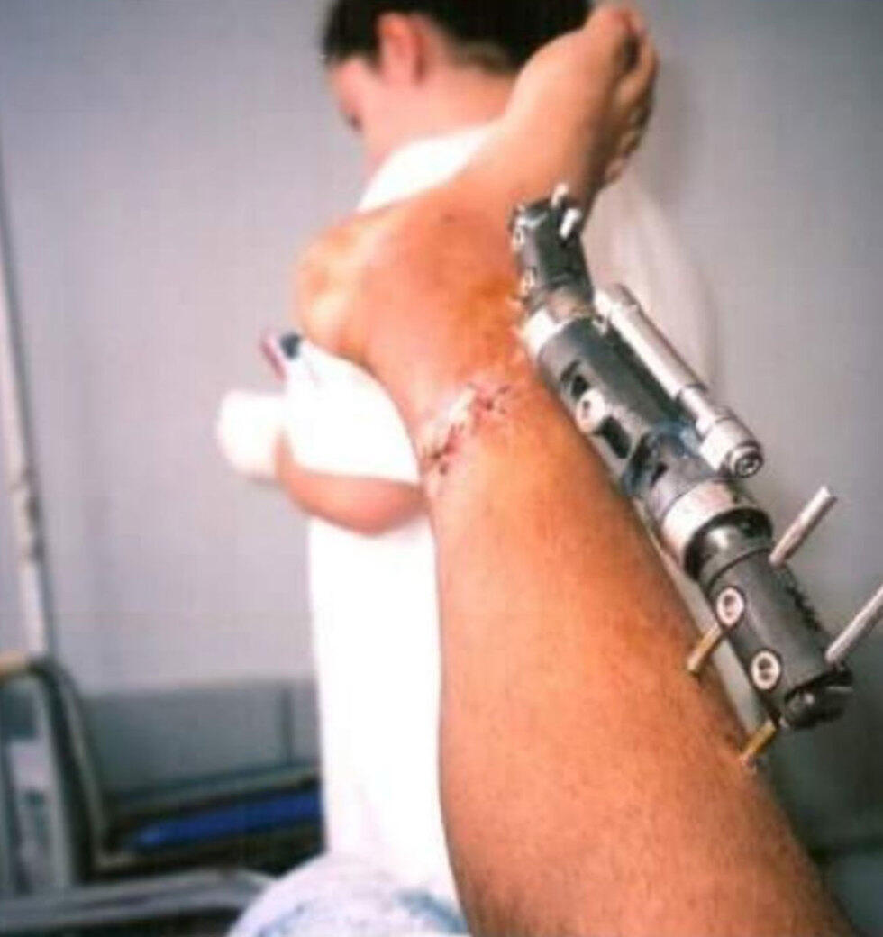 После ранения. Ступню пришили на местоnullnull После ранения. Ступню пришили на место