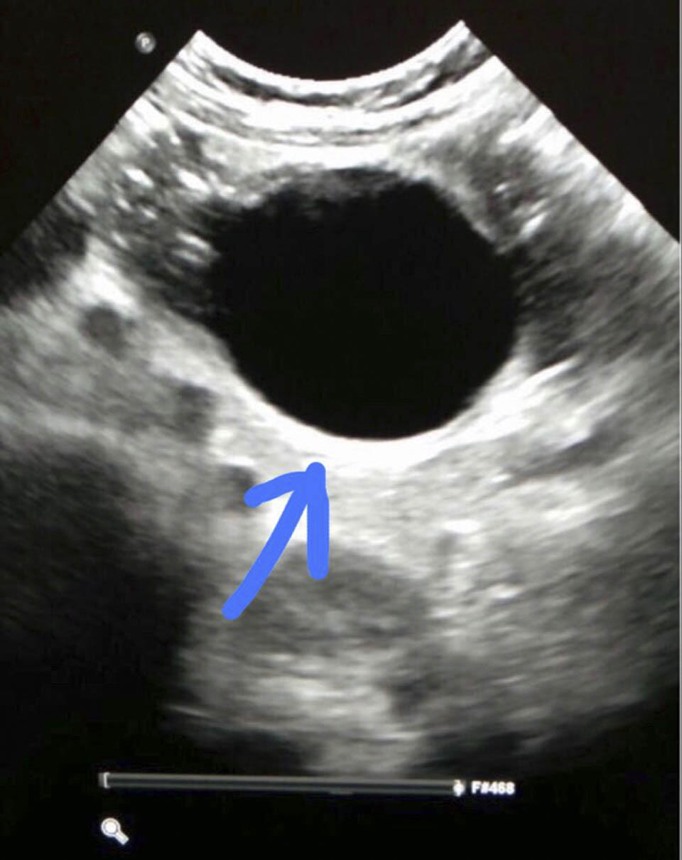 Шарик в животе у малыша. Рентгеновский снимок из больницы "Шнайдер" (Фото: пресс-служба) Шарик в животе у малыша. Рентгеновский снимок из больницы "Шнайдер"