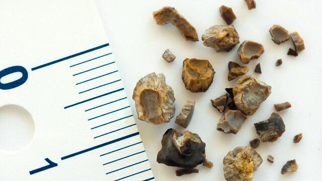 Камни из почек. Фото: shutterstock (צילום: shutterstock) Камни из почек. Фото: shutterstock