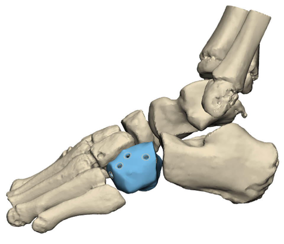 Имплантация протеза предотвратила ампутацию стопы. Фото: пресс-служба больницы "Ихилов" (Фото: пресс-служба больницы "Ихилов") Имплантация протеза предотвратила ампутацию стопы. Фото: пресс-служба больницы "Ихилов"