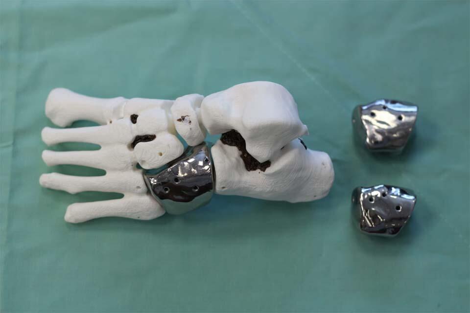 Протез с трехмерного принтера. Фото: пресс-служба "Ихилов" (Фото: пресс-служба больницы "Ихилов") Протез с трехмерного принтера. Фото: пресс-служба "Ихилов"