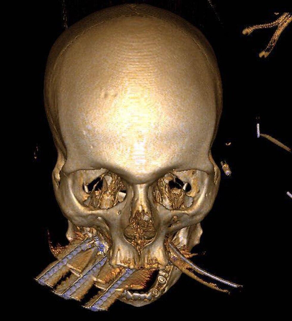 Томография черепа пострадавшего (צילום: המרכז הרפואי זיו בצפת) Томография черепа пострадавшего