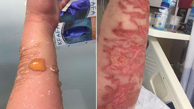  Ожог от медузы. Фото: больница "Шиба"