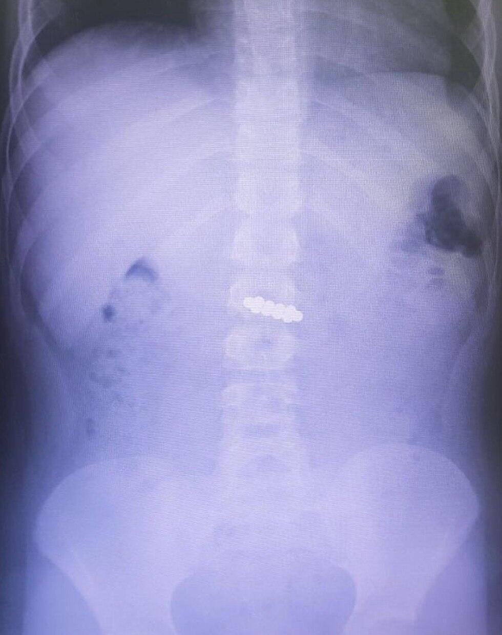 Рентгеновский снимок мальчика с проглоченными магнитами Рентгеновский снимок мальчика с проглоченными магнитами