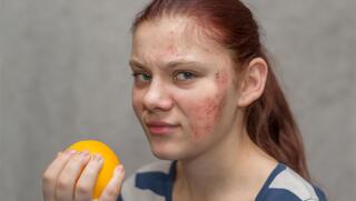 אטופיק דרמטיטיס