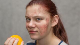 אטופיק דרמטיטיס