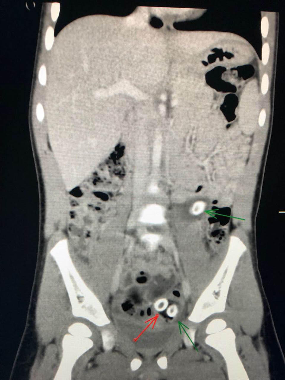 Рентгеновский снимок, стрелкой обозначены косточки от оливок. Фото: "Шнайдер" (Фото: пресс-служба больницы "Шнайдер") Рентгеновский снимок, стрелкой обозначены косточки от оливок. Фото: "Шнайдер"