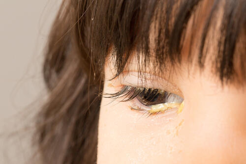 Конъюнктивит. Фото: shutterstock (Фото: shutterstock) Конъюнктивит. Фото: shutterstock