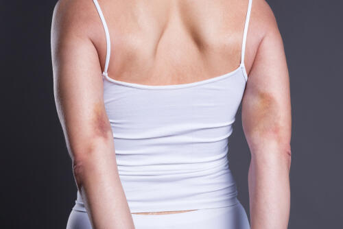 Следы насилия. Фото: shutterstock (Следы насилия. Фото: shutterstock) Следы насилия. Фото: shutterstock