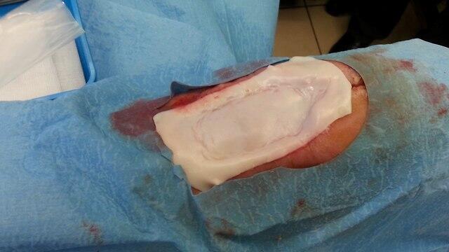 Личинки достают до глубоких мест, к которым трудно подобраться скальпелем. Фото: Koko (צילום: Koko) Личинки достают до глубоких мест, к которым трудно подобраться скальпелем. Фото: Koko