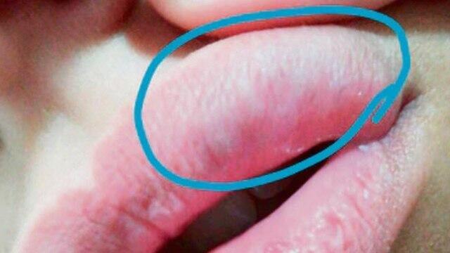 Последствия укола. Фотоиллюстрация Последствия укола. Фотоиллюстрация