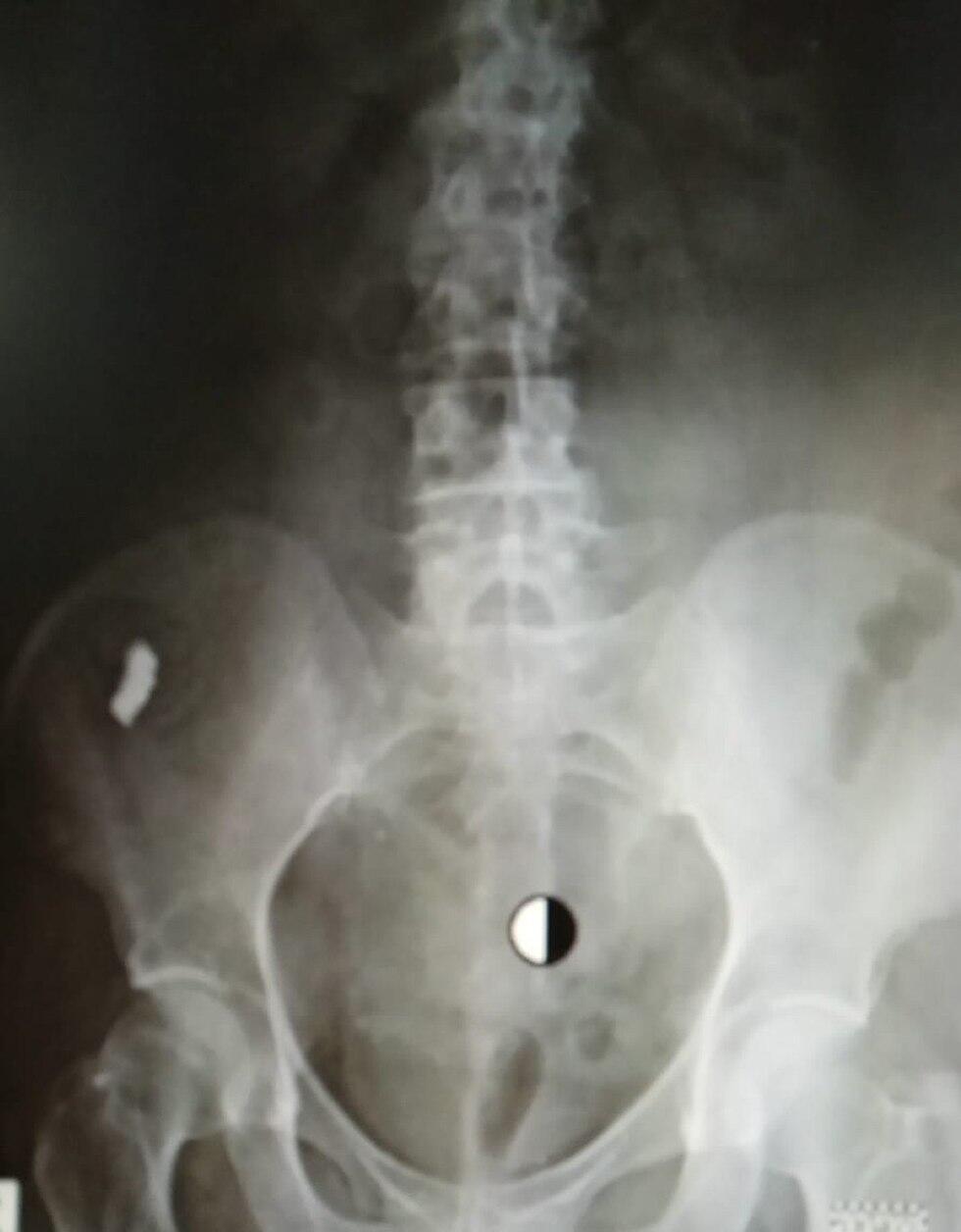 Проглоченный протез на рентгенограмме Проглоченный протез на рентгенограмме