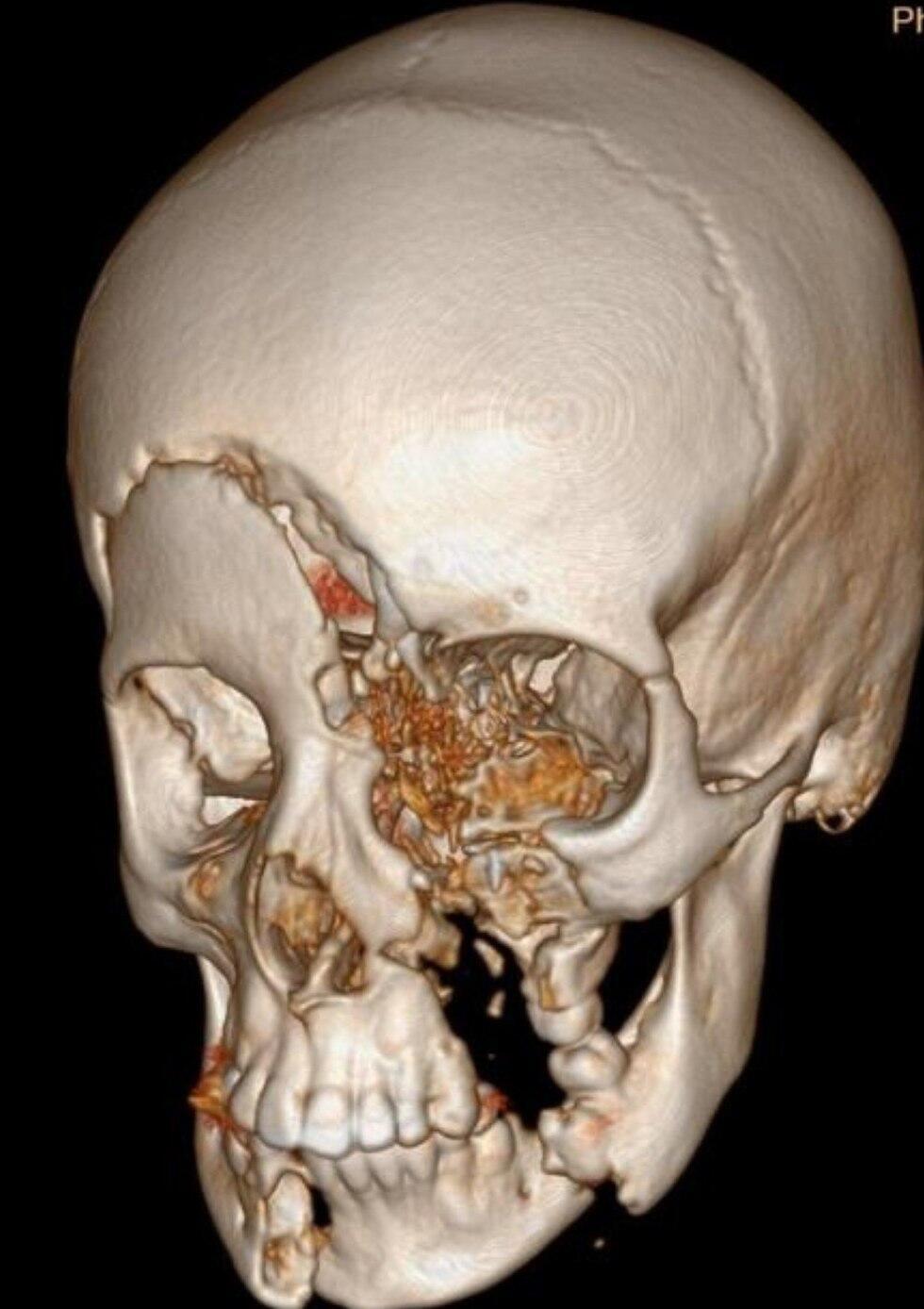Трехмерный снимок повреждений, полученных мальчиком Трехмерный снимок повреждений, полученных мальчиком