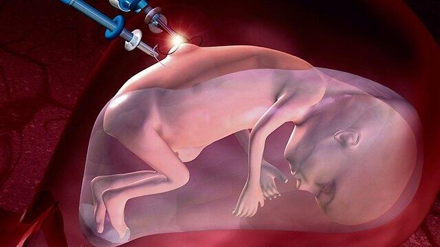 Один из этапов операции по коррекции позвоночника плода (באדיבות ד"ר דניס לאפה) Один из этапов операции по коррекции позвоночника плода