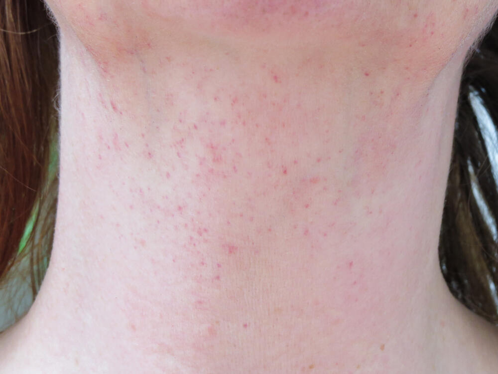 Сыпь при менингококковой инфекции. Фото: shutterstock (Фото: shutterstock) Сыпь при менингококковой инфекции. Фото: shutterstock