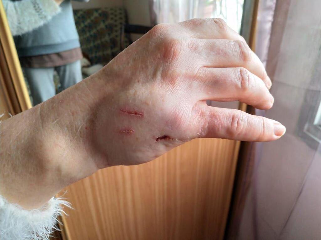 Сделала замечание и получила удары палкой. Фото предоставлено пострадавшей (Фото предоставлено пострадавшей) Сделала замечание и получила удары палкой. Фото предоставлено пострадавшей