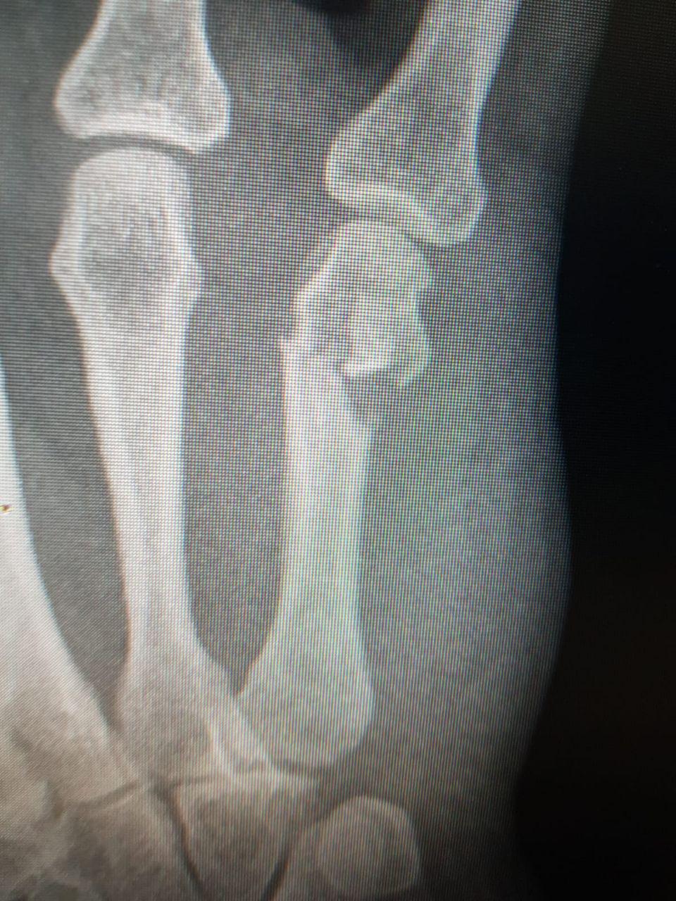 Перелом кисти в четырех местах выбил Наталью из колеи надолго. Фото предоставлено пострадавшей (Фото предоставлено пострадавшей) Перелом кисти в четырех местах выбил Наталью из колеи надолго. Фото предоставлено пострадавшей