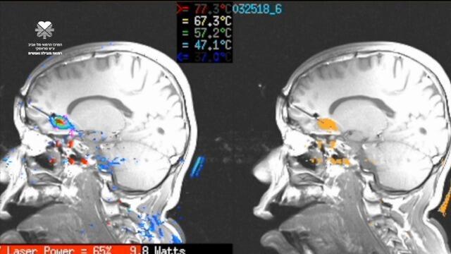 Прижигание очага эпилепсии (выделено делтым). Фото: Лиор Цур