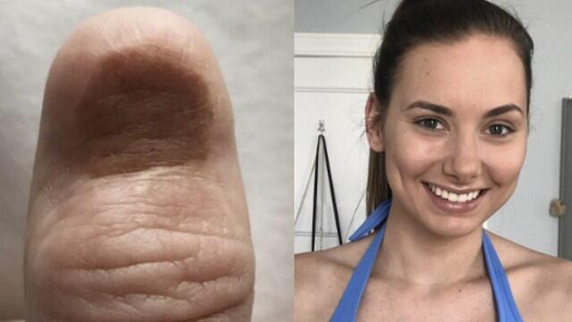 Каролина Яско и пострадавший палец Каролина Яско и пострадавший палец