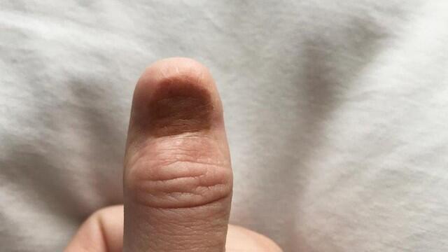 Так выглядит палец Каролины после операции по удалению меланомы Так выглядит палец Каролины после операции по удалению меланомы