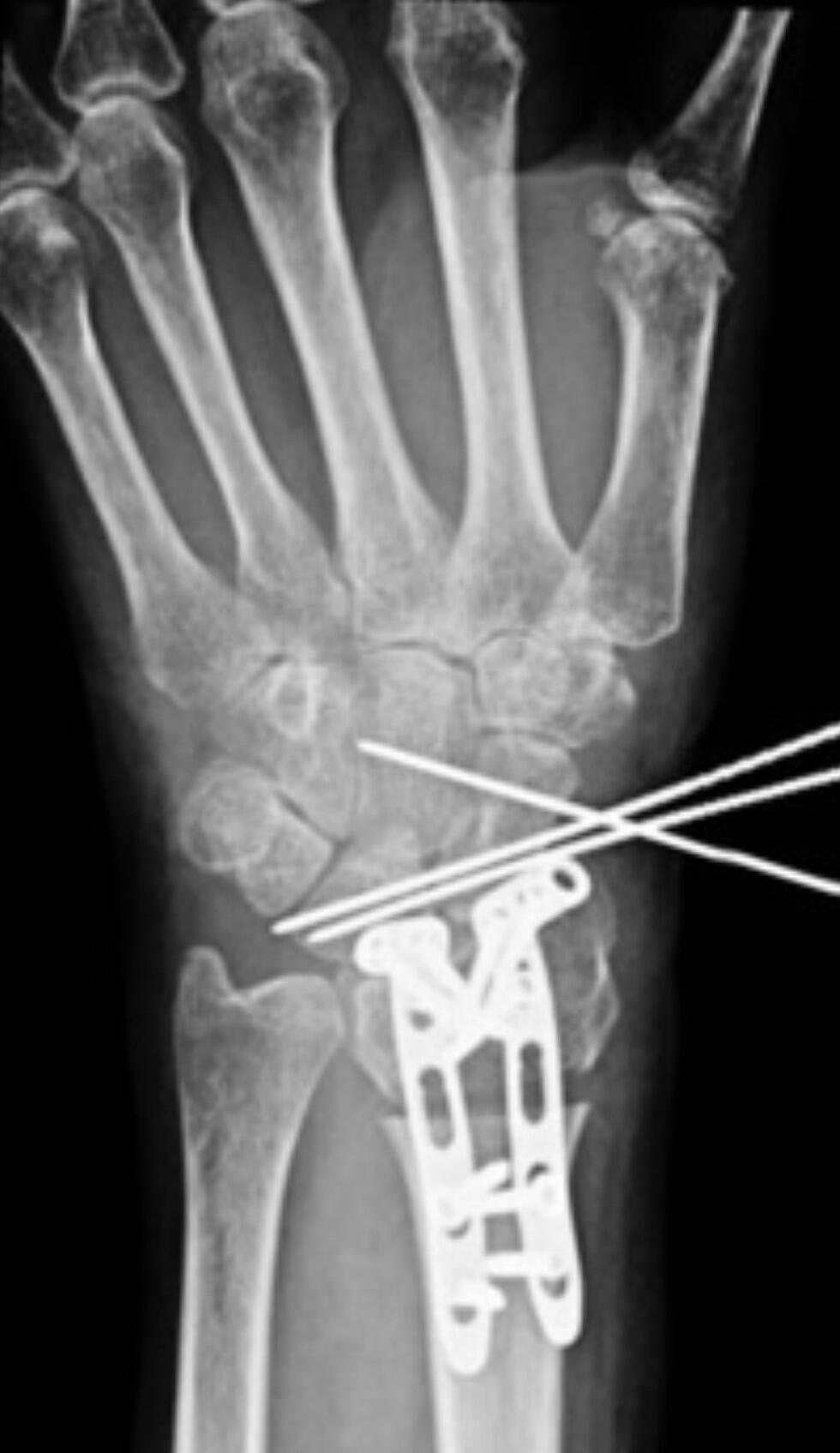 Рентгенограмма кисти 57-летней женщины, у которой не заживал перелом запястья из-за привычки набирать текстовые сообщения. Снимок предоставлен д-ром Лурьe Рентгенограмма кисти 57-летней женщины, у которой не заживал перелом запястья из-за привычки набирать текстовые сообщения. Снимок предоставлен д-ром Лурьe